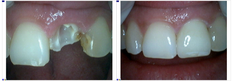 
Реставрационная стоматология и виды восстановления зубов
