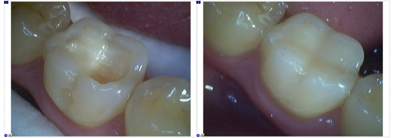 
Реставрационная стоматология и виды восстановления зубов

