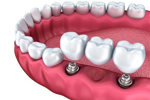 
Зубные имплантаты: только факты
